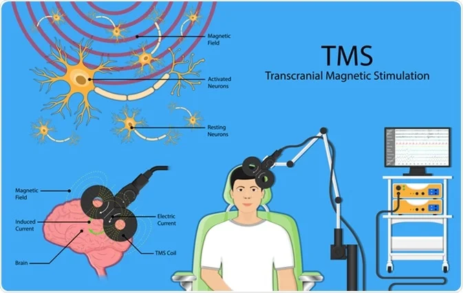 Depression Treatment with TMS | Prodigy Clinic