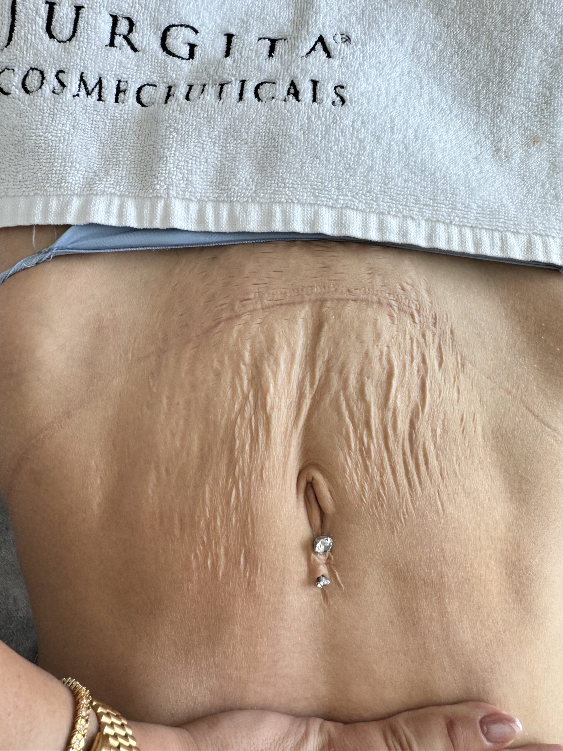 Stretch Marks Treatment in Dubai | Stria Repair & Removal UAE