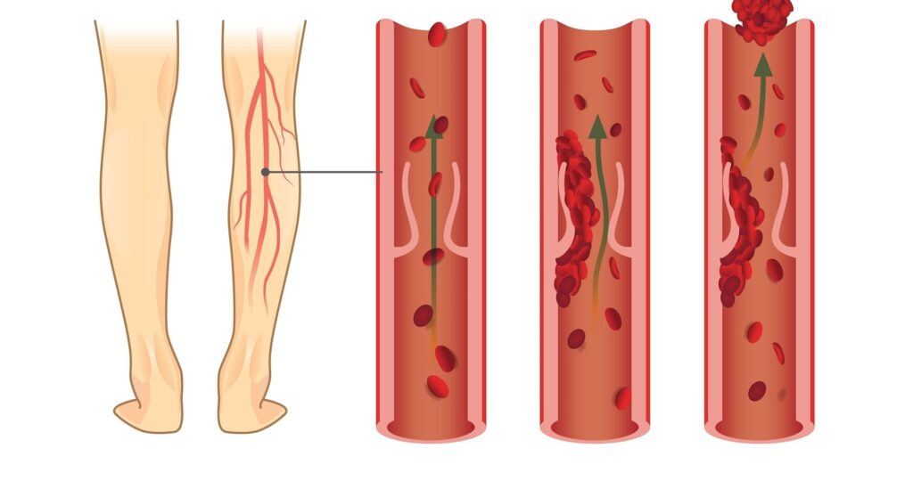 Best Deep Vein Thrombosis Treatment In Delhi - Dr. Nikhil Chaudhari