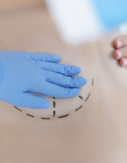 Breast Lift Surgery in Kochi, India | Mastopexy