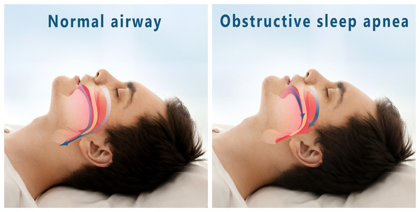 Sleep Apnea Treatments, Causes & Symptoms | Sacramento, CA