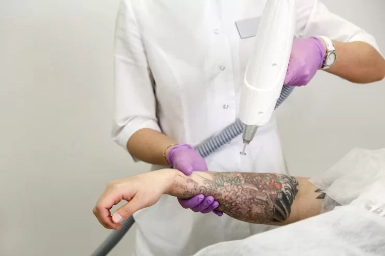 Getting a Tattoo vs Laser Tattoo Removal: What Hurts More?