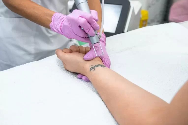 Unremovable Tattoos That Can not Be Removed and Why?