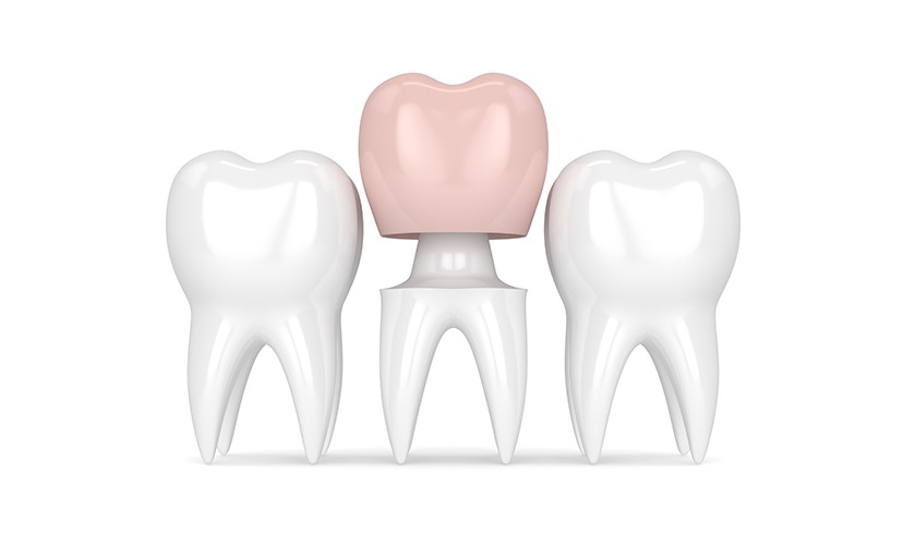 Dental Crowns replaced in Dublin | 24 hour Emergency Dentist Near Me | 7DayDentist