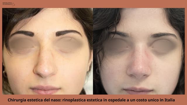 Chirurgia estetica del naso: rinoplastica estetica in ospedale a un costo unico in Italia | PPTX
