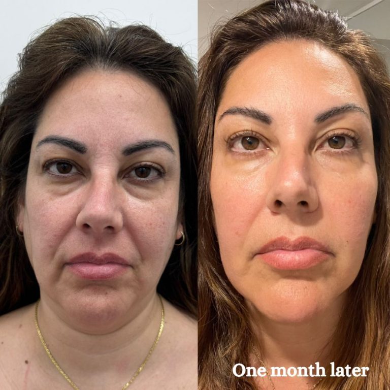 HIFU Treatment Melbourne | HIFU Facial | Ultraformer MPT