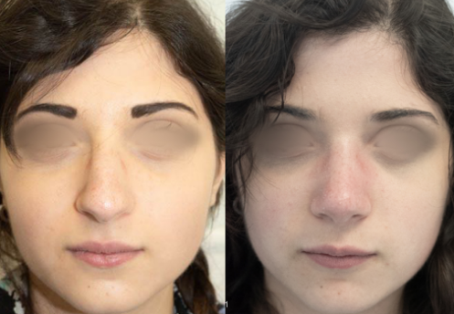 Chirurgia estetica del naso: rinoplastica estetica in ospedale a un costo unico in Italia | by Rinoplasticaospedale | Oct, 2025 | Medium