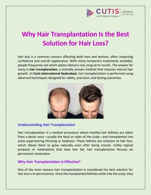 Why Hair Transplantation Is the Best Solution for Hair Loss? | PDF