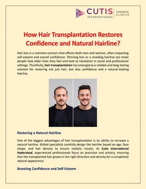 How Hair Transplantation Restores Confidence and Natural Hairline? | PDF