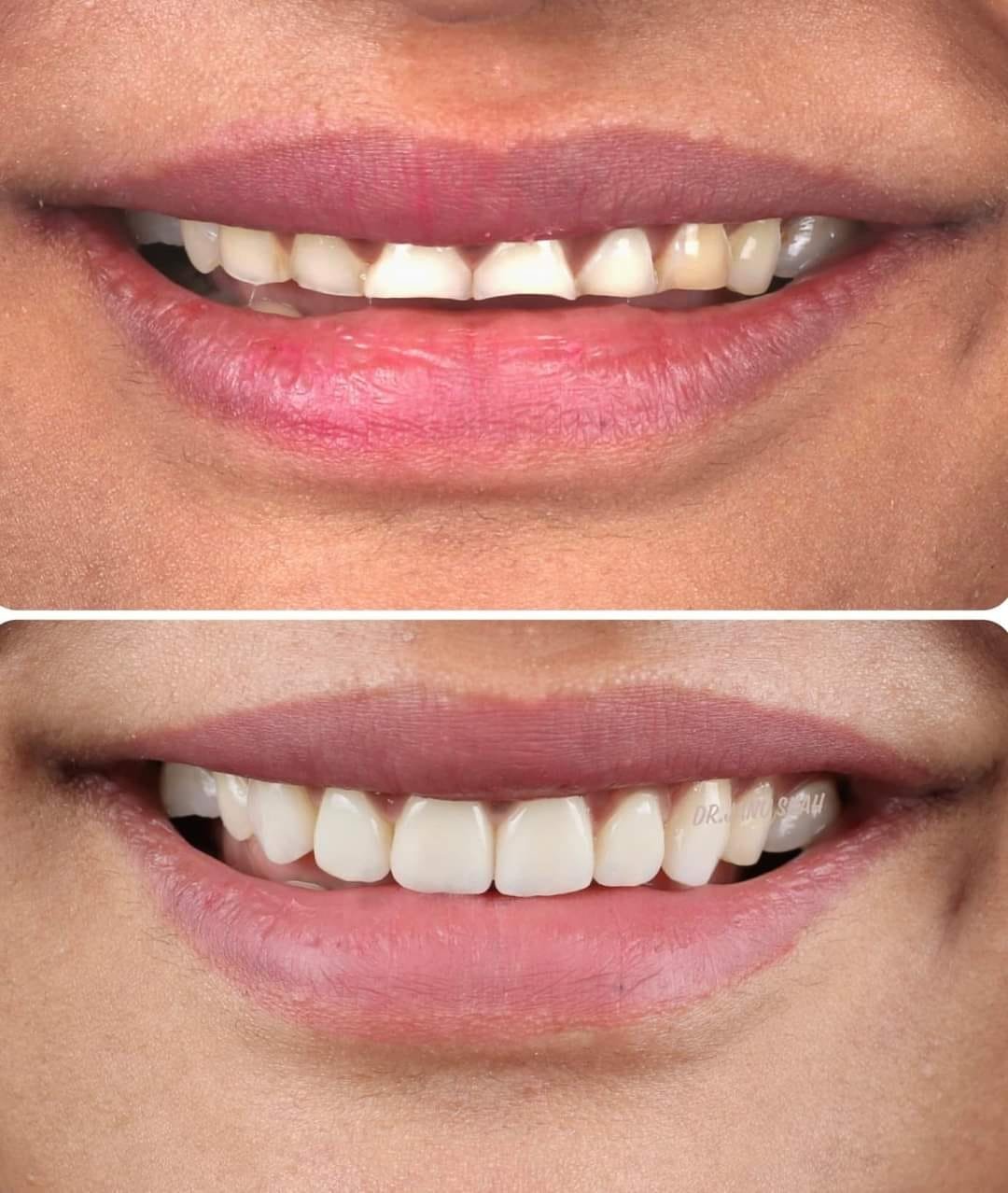 Best Smile Designing Treatment in Madhapur | Olive's Dental World