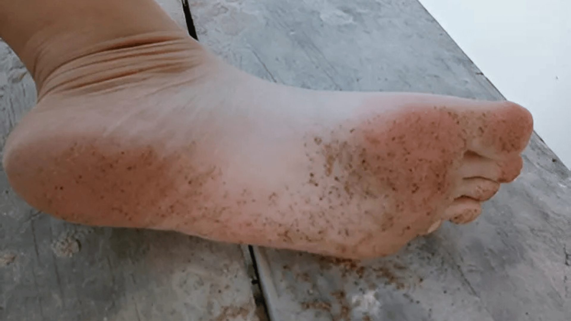 10 Warning Signs Why You Might Have black spots on bottom of feet