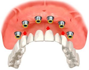 Dental Implants After Chemotherapy: Options for Replacing Lost Teeth