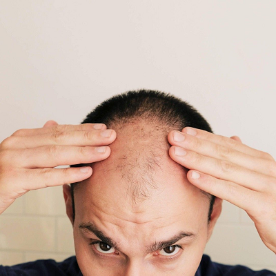 Hair Loss Treatment in Islamabad