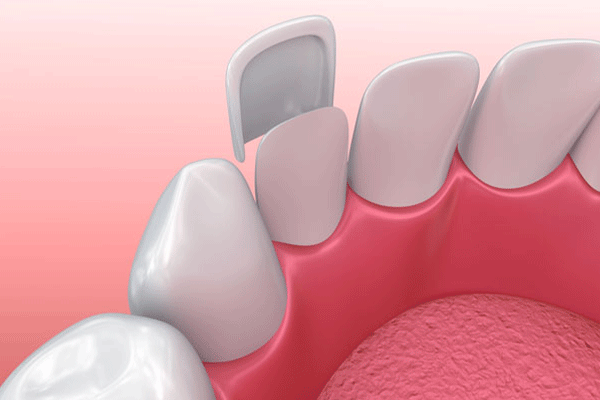 Dental Veneers Canberra | Molonglo Dental Surgery | 02 62871222