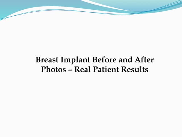 Breast Implant Before and After Photos – Real Patient Results