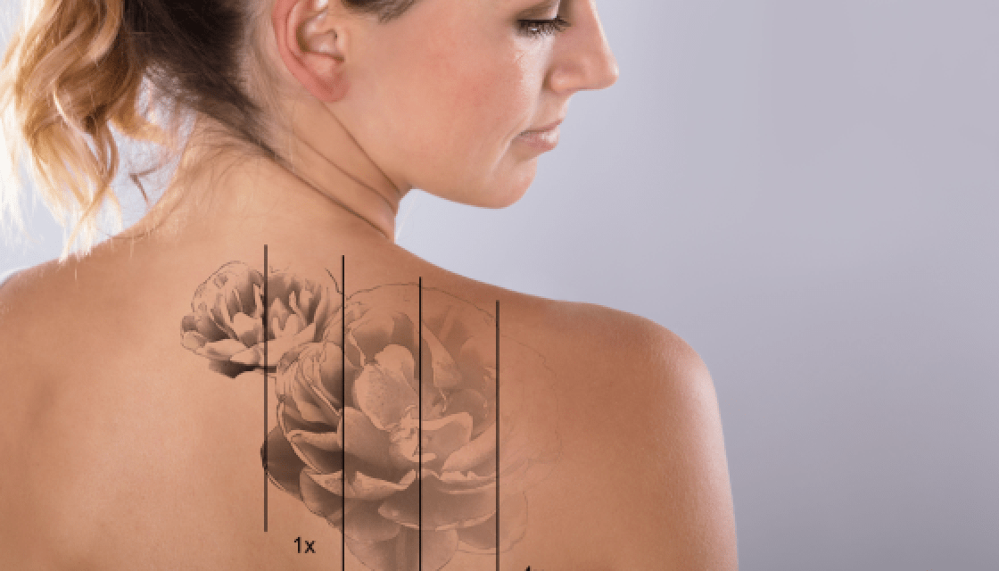 Laser Tattoo Removal in Paramus NJ | Laser Eraser