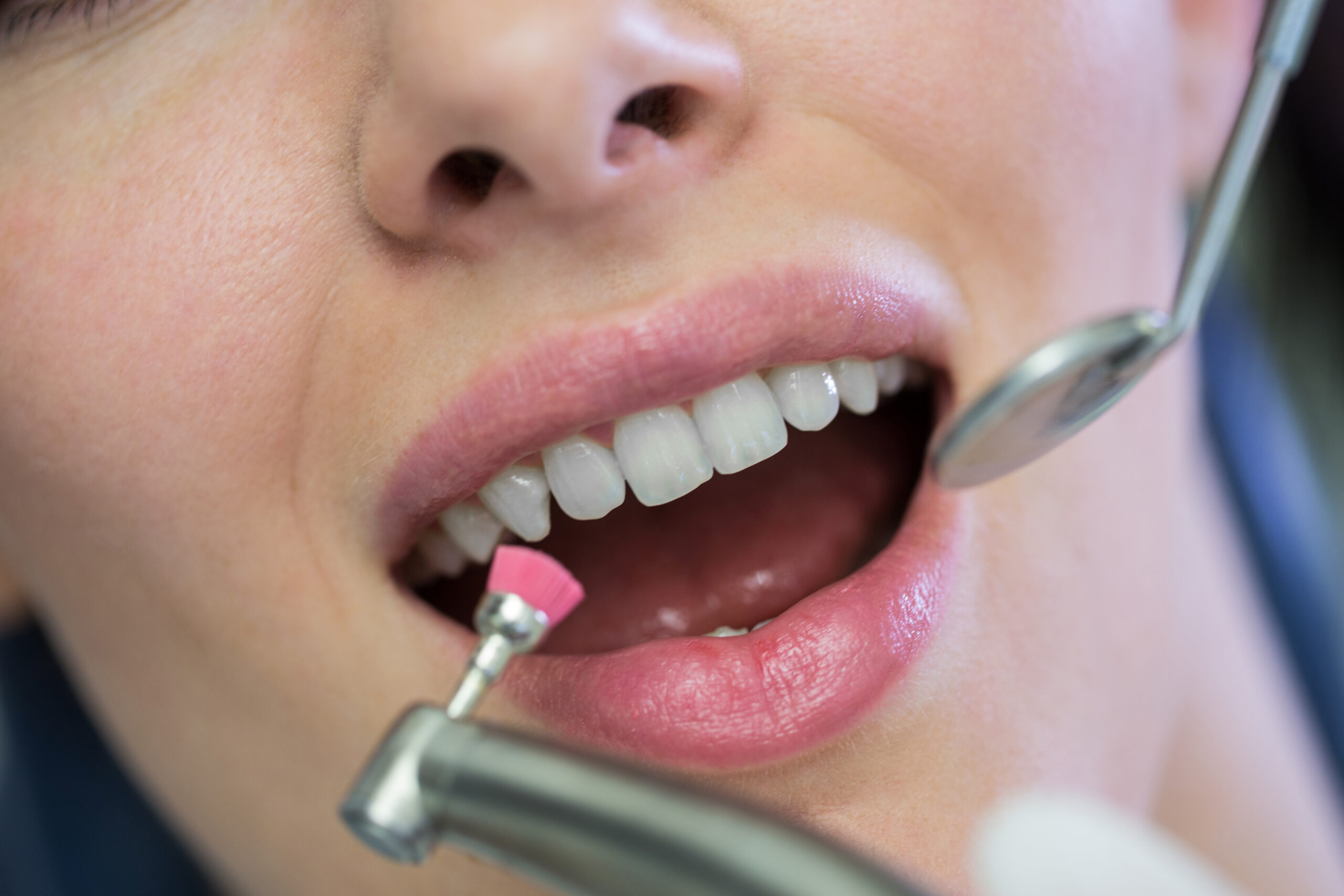 Scaling and Polishing in Ajman | Healthy & Bright Smile
