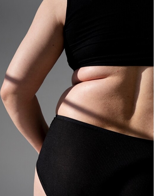 HD Liposuction in Kochi, India | High-Definition BodySculpting