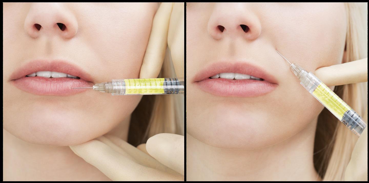 Organic Filler (Plasma Gel) - Natural Beauty Enhancement