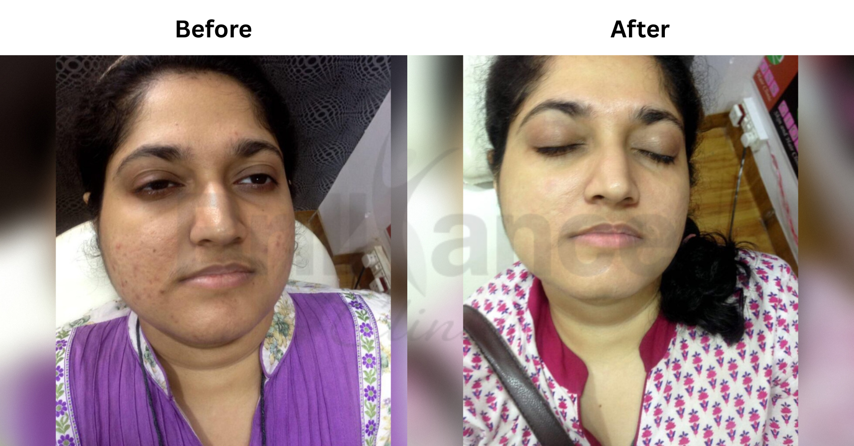 Glutathione IV Drip Treatment in Mumbai - brillianceclinic.com