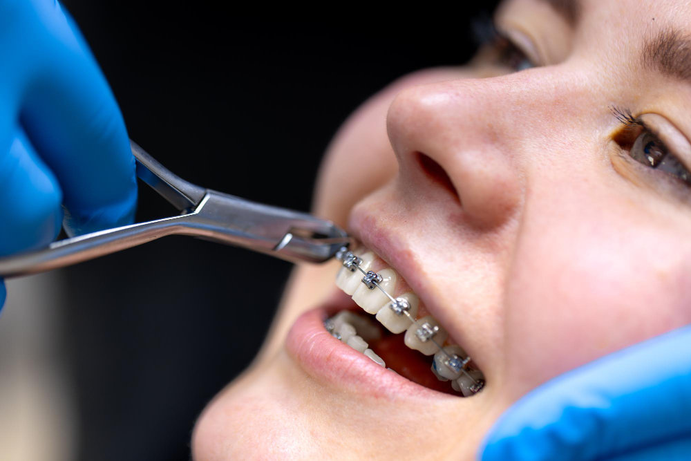 How Braces Help Correct Crooked Teeth and Bite Problems
