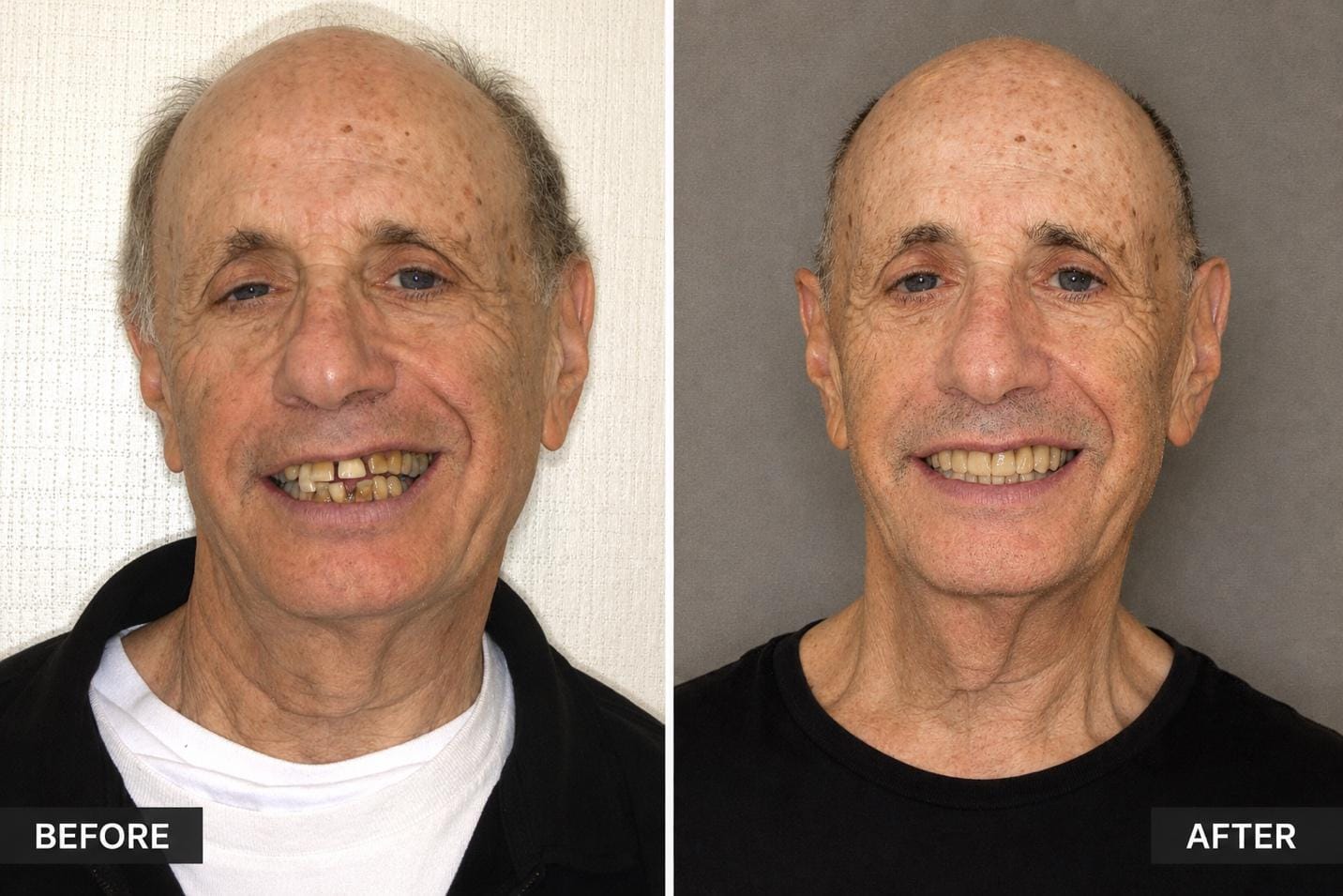 How Philip Overcame Decades of Dental Phobia and Found His Smile Again - CitySpireDental