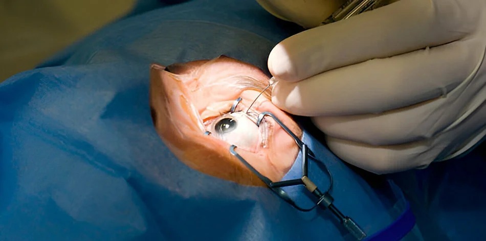 Best Cataract Surgery Cost in Faridabad