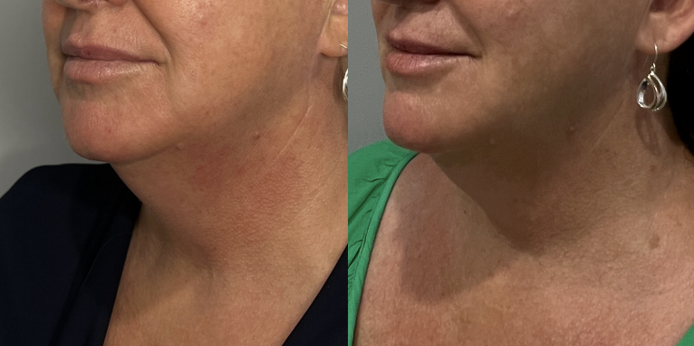 HIFU Melbourne | HIFU Facial & Ultraformer MPT Skin Tightening