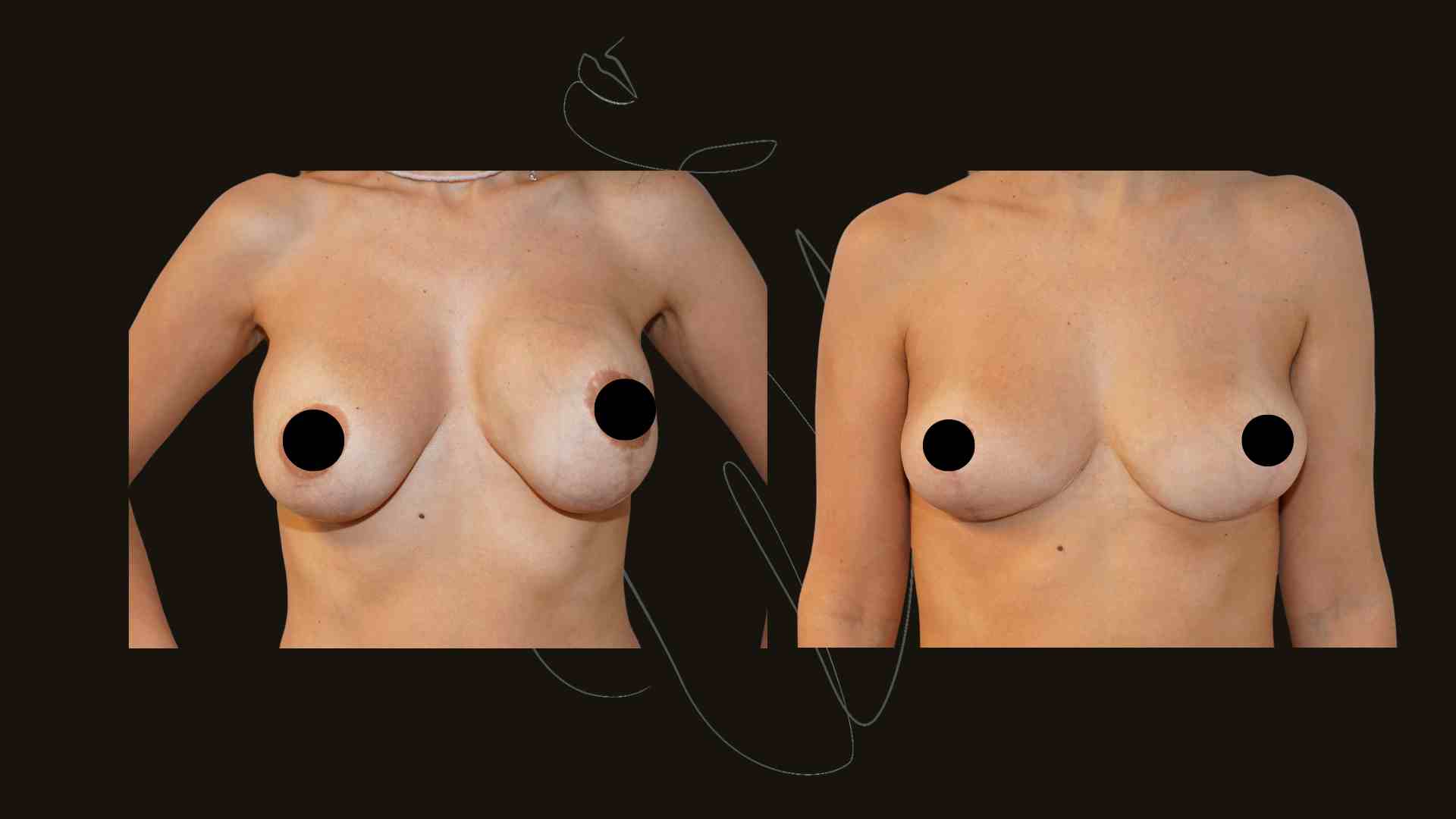 Breast Implant Removal NYC | Explant Surgery NYC