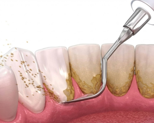Periodontal Therapy in Lowell MA | Gum Disease Treatment